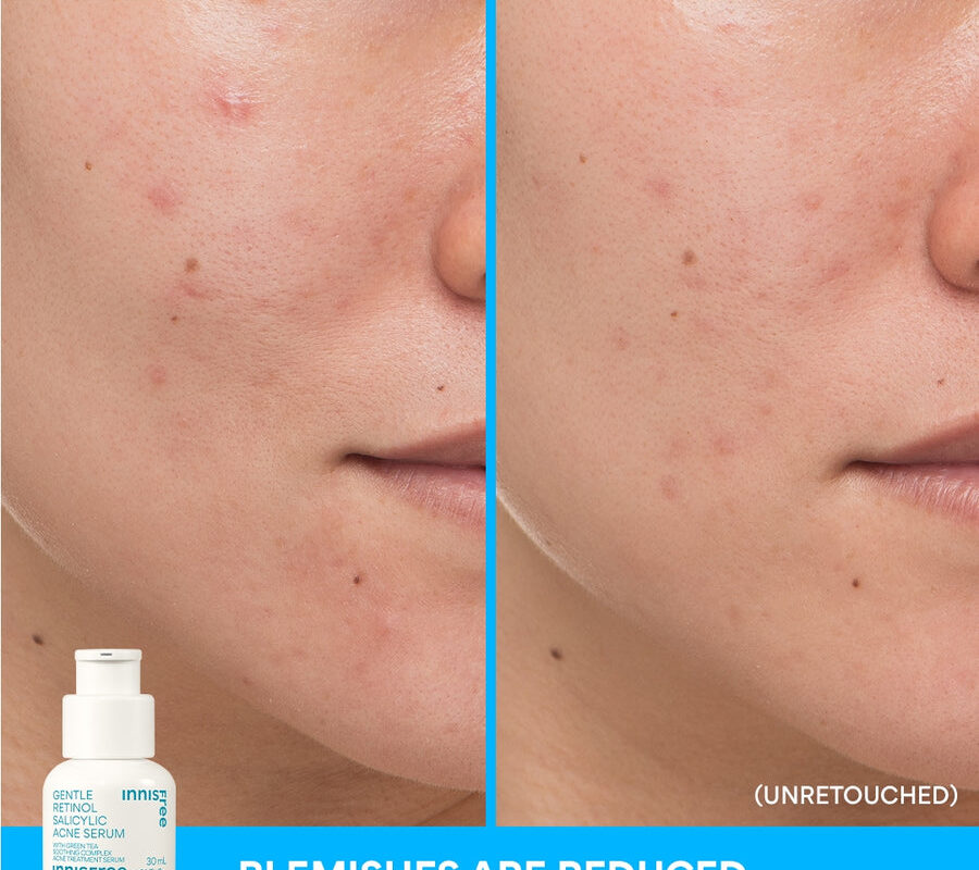 Acne Treatment